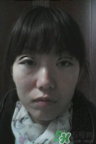 什么是定點(diǎn)雙眼皮？定點(diǎn)雙眼皮多少錢？