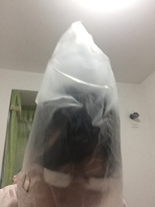 定點(diǎn)雙眼皮恢復(fù)過(guò)程圖_定點(diǎn)雙眼皮要多久恢復(fù)