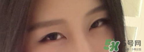 切開雙眼皮多久消腫？切開雙眼皮多久恢復？