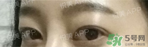 埋線雙眼皮多久恢復(fù)自然？埋線雙眼皮多久能恢復(fù)