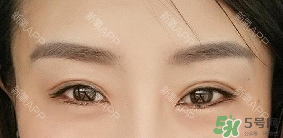 埋線(xiàn)雙眼皮能保持多久？埋線(xiàn)雙眼皮是永久嗎