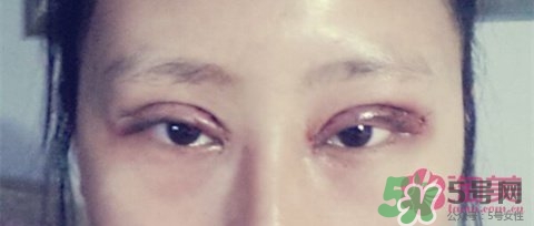 切開雙眼皮多久消腫？切開雙眼皮多久恢復？