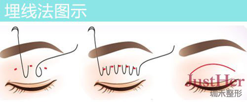 定點(diǎn)雙眼皮怎么做？定點(diǎn)雙眼皮需要拆線嗎？