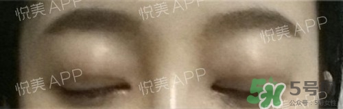 埋線雙眼皮多久恢復(fù)自然？埋線雙眼皮多久能恢復(fù)