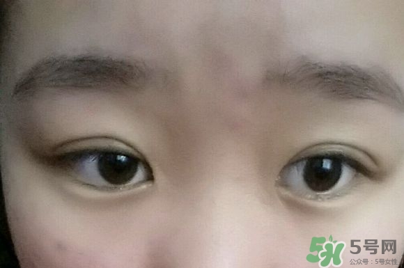 埋線雙眼皮需要拆線嗎？埋線雙眼皮怎么拆線