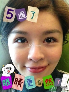 重瞼術(shù)是什么？重瞼術(shù)是永久的嗎？