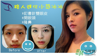 重瞼術(shù)是什么？重瞼術(shù)是永久的嗎？