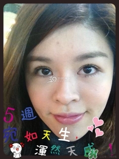 重瞼術(shù)是什么？重瞼術(shù)是永久的嗎？