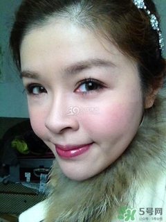 重瞼術(shù)是什么？重瞼術(shù)是永久的嗎？