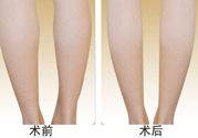 小腿吸脂多久見效？小腿吸脂后多久能看見效果？