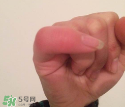 小拇指凍腫了怎么辦？為什么小拇指容易凍？