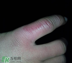 小拇指凍腫了怎么辦？為什么小拇指容易凍？