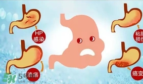 神經(jīng)性胃痙攣是什么？神經(jīng)性胃痙攣是什么原因？