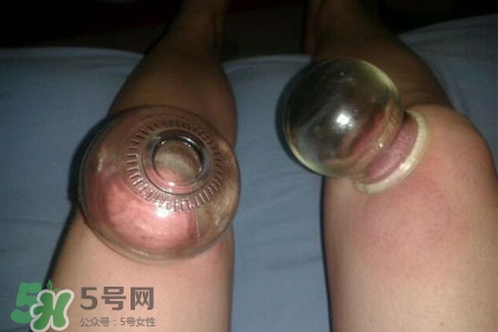拔罐瘦腿真的有效嗎？腿部拔火罐減肥效果好嗎？