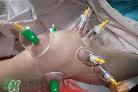 小腿能拔罐嗎？在小腿上拔火罐有什么作用？