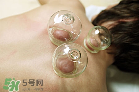 拔罐分季節(jié)嗎？不同季節(jié)的拔罐禁忌