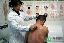 刮痧可以減肥嗎？刮痧減肥有效果嗎？
