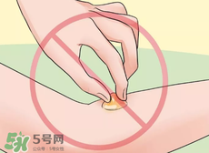 水泡怎么處理？水泡要不要刺破？