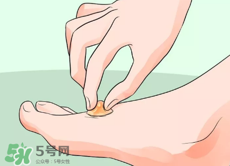 水泡怎么處理？水泡要不要刺破？