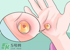 水泡怎么處理？水泡要不要刺破？