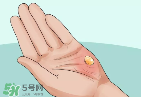 水泡怎么處理？水泡要不要刺破？