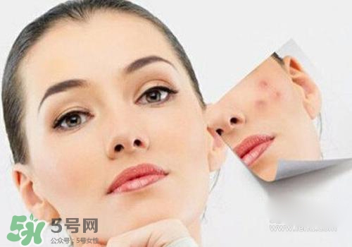 封閉性粉刺會自己消失嗎？封閉性粉刺好了會留疤嗎？