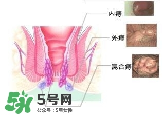 痔瘡吃什么藥效果好？痔瘡吃什么藥好得快？