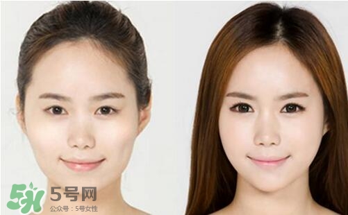 瘦臉針分為幾種類型？瘦臉針有哪幾個(gè)牌子？