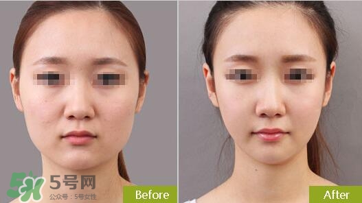 瘦臉針分為幾種類型？瘦臉針有哪幾個(gè)牌子？