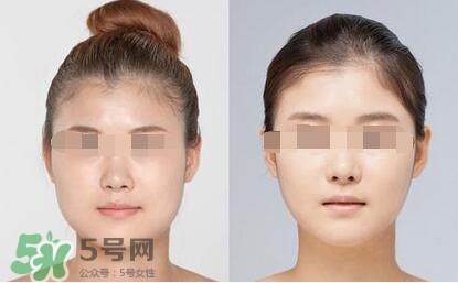 瘦臉針分為幾種類型？瘦臉針有哪幾個(gè)牌子？