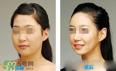 瘦臉針分為幾種類型？瘦臉針有哪幾個(gè)牌子？