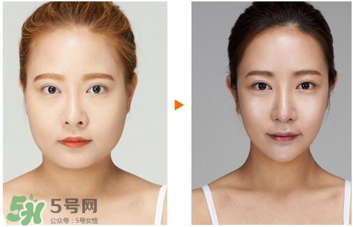 瘦臉針分為幾種類型？瘦臉針有哪幾個(gè)牌子？