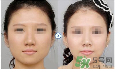 打瘦臉針疼不疼？打瘦臉針的注意事項(xiàng)