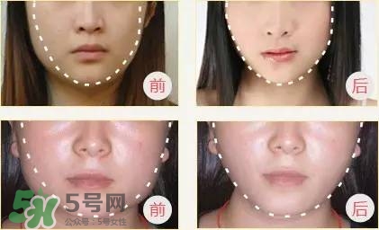 打完瘦臉針多久可以化妝？打完瘦臉針的反應(yīng)