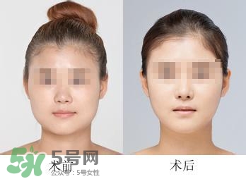 打瘦臉針能喝酒嗎？打瘦臉針能吃海鮮嗎？