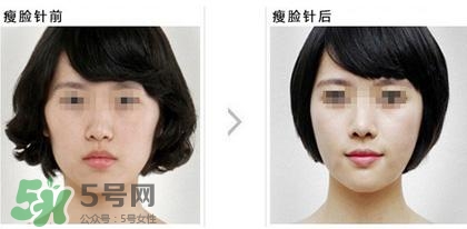 打瘦臉針能喝酒嗎？打瘦臉針能吃海鮮嗎？