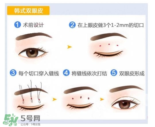 割雙眼皮有幾種做法？雙眼皮有哪幾種形狀？