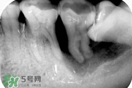 智齒會引起耳鳴嗎？耳鳴跟智齒有關(guān)系嗎？