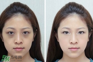 臥蠶是黑眼圈嗎？臥蠶和黑眼圈的區(qū)別