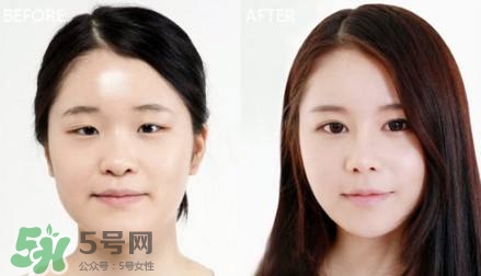 割雙眼皮有什么后遺癥嗎？割雙眼皮有什么危害性？