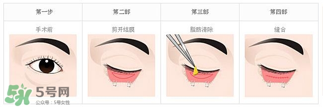 眼袋是怎么形成的？手術(shù)去眼袋安全嗎