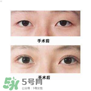 割雙眼皮疼不疼？割雙眼皮疼幾天能好？