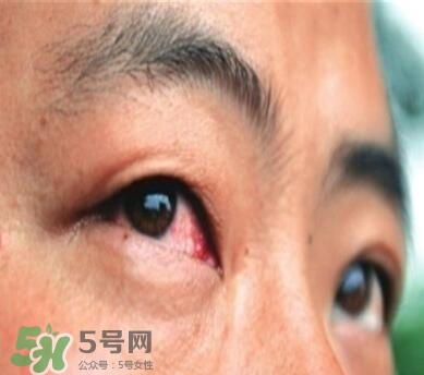 紅眼病是怎么引起的？紅眼病怎么產(chǎn)生的