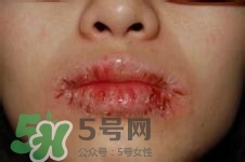 嘴唇干燥是什么原因？嘴唇干裂脫皮怎么辦？