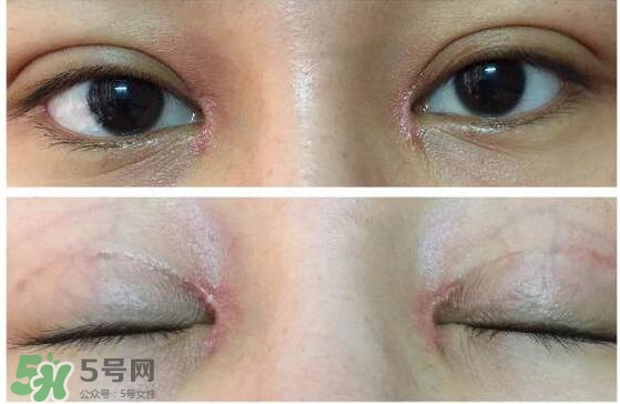 眼角增生是什么意思？眼角增生了怎么辦？
