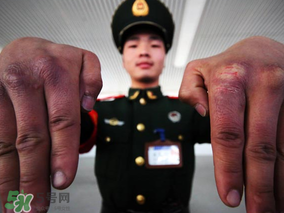 三月份還長凍瘡嗎？三月份凍瘡沒好怎么辦？
