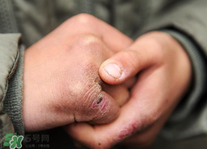 三月份還長凍瘡嗎？三月份凍瘡沒好怎么辦？