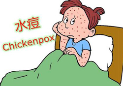 水痘是天花嗎？水痘是不是天花？