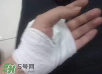 傷口化膿怎么處理？傷口化膿用什么藥好？