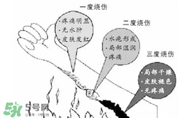 燙傷起泡要挑破嗎？燙傷起泡怎么處理？